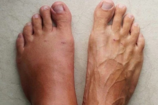 6 dấu hiệu cho thấy thận có thể sắp hỏng