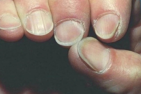 6 bệnh lý có thể phát hiện qua hình dáng móng tay