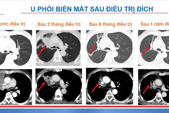 Phát hiện trường hợp viêm ruột thừa cấp tính do ung thư phổi di căn hiếm gặp