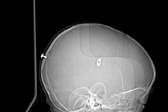 Phẫu thuật thành công cho bé trai bị đinh vít đâm vào đầu