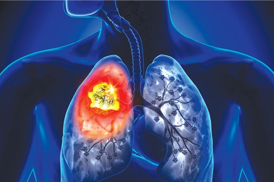 Hút thuốc lá làm ung thư ở 10 bộ phận của cơ thể