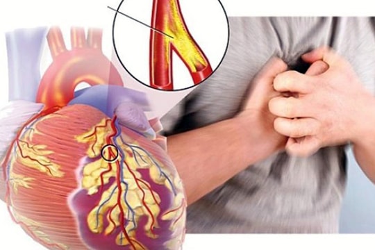 Hút thuốc lá là tác nhân gây nên nhiều bệnh về tim mạch