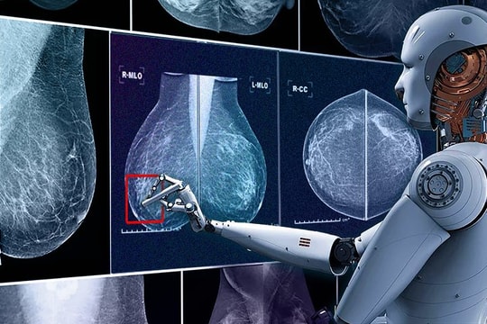 Trí tuệ nhân tạo đóng vai trò như thế nào trong cuộc chiến chống ung thư vú?