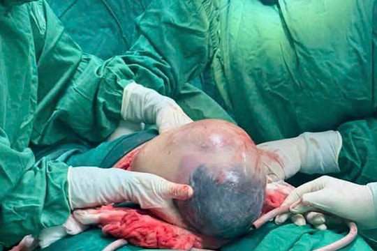 Hy hữu bé trai chào đời vẫn nằm trong bọc ối ở Nghệ An