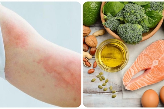 Dấu hiệu thiếu Omega-3 bạn không nên chủ quan