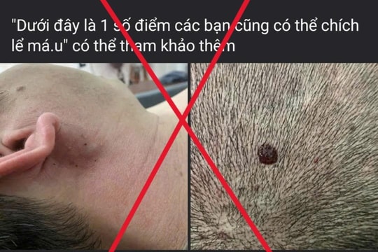 Bác sĩ cảnh báo về các sai lầm trong sơ cứu bệnh nhân đột quỵ