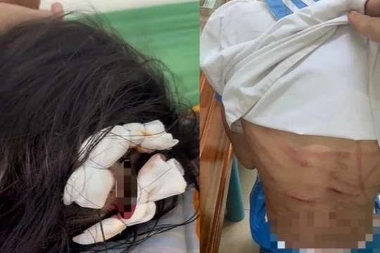 Nữ hiệu trưởng rụng rời khi bé gái lớp 5 thương tích khắp người, nghi bị bố dượng đánh