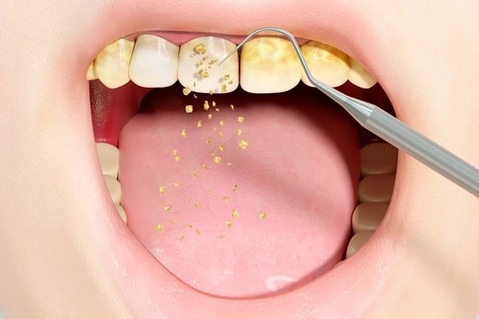 Hậu quả đáng lo ngại khi lười lấy cao răng và dấu hiệu bạn cần gặp nha sĩ ngay