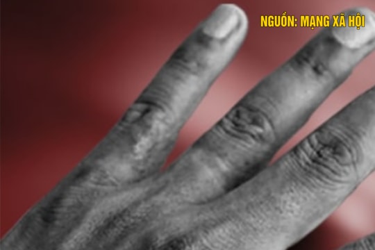 Chủ quán thịt chó bất ngờ tử vong do bệnh dại
