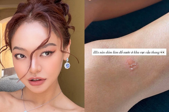 Đại diện Việt Nam Mai Ngô gặp chấn thương trước phần thi Top Model tại Miss Supranational 2026