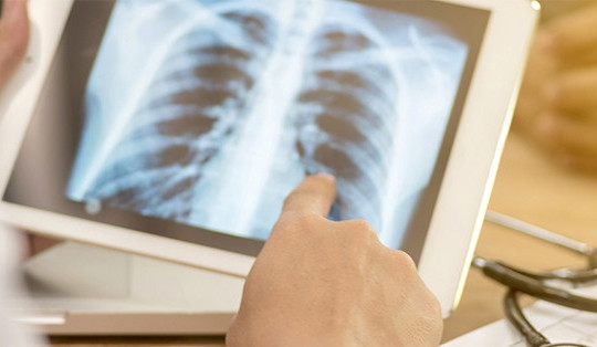 Chuyên gia Bệnh viện Bạch Mai chỉ ra 4 tác nhân gây ung thư phổi dù không hút thuốc