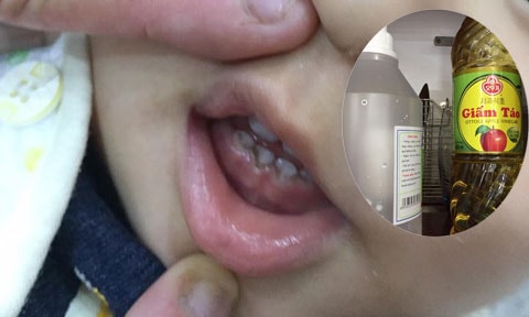 Cách đơn giản làm sạch mảng bám đen trên răng của trẻ