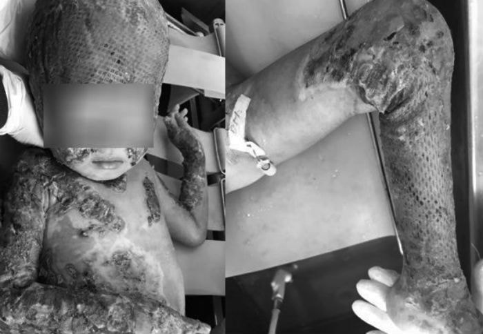 Người cha hiến da ghép cho con bị cháy toàn bộ cơ thể