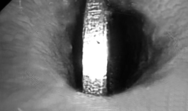 Đồng xu kẹt cứng trong thực quản bé gái 5 tuổi