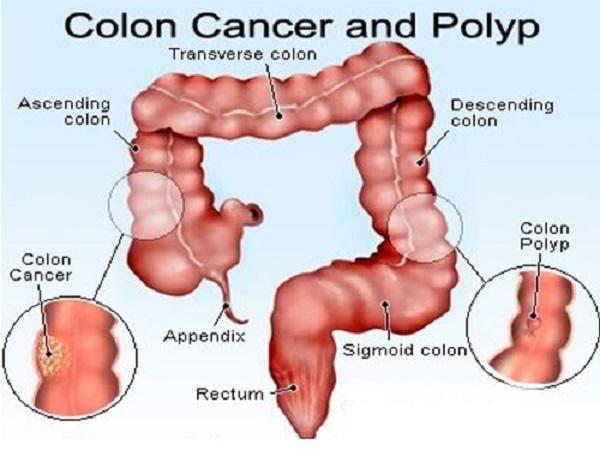 Tầm soát ung thư đại trực tràng thế nào là đúng