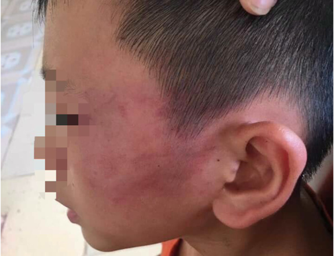 Xác minh vụ bé trai 12 tuổi nghi bị mẹ kế đánh