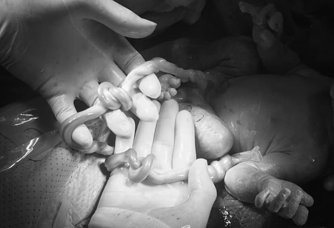 Cặp song sinh chào đời với hai dây rốn cùng thắt nút