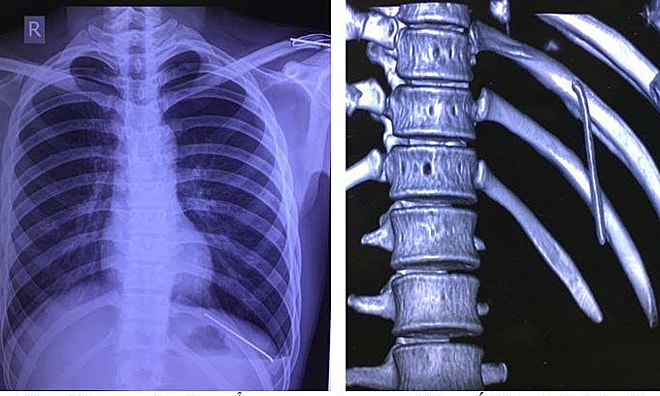 Chiếc đinh tự di chuyển từ vai xuống phổi chàng trai 18 tuổi