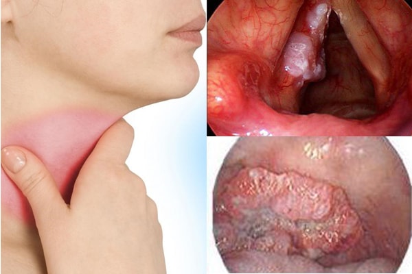 5 dấu hiệu ung thư thanh quản nhiều người thường bỏ qua