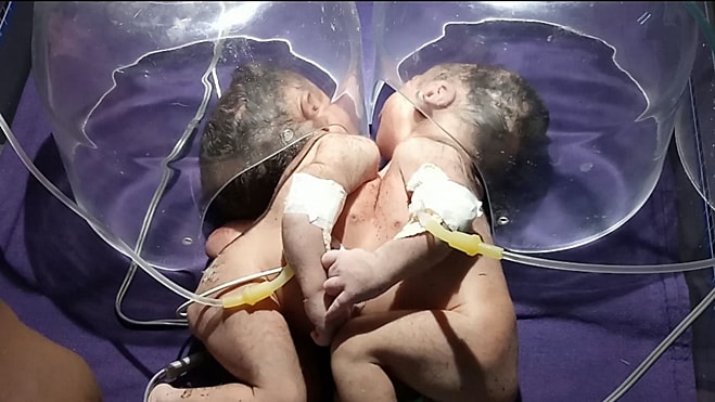 Cặp song sinh dính liền chung một trái tim