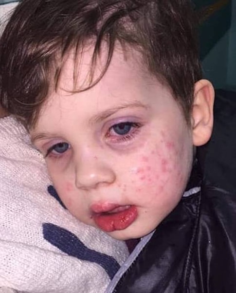 Bé trai 3 tuổi nhiễm virus bệnh tình dục sau nụ hôn vào má