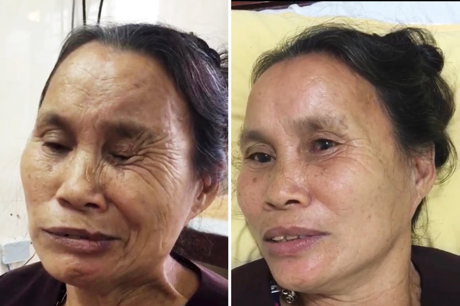 Bệnh viện Phục hồi chức năng Nghệ An: Điều trị hiệu quả đau dây thần kinh số V