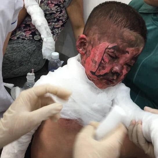 Nghịch bật lửa đốt giấy gây cháy, hai cháu bé ở Nghệ An bị bỏng nặng