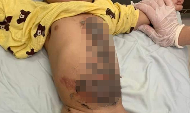 Cấp cứu cho trẻ bị bỏng được thầy lang sơ cứu bằng cách đắp lông chó vào vết thương