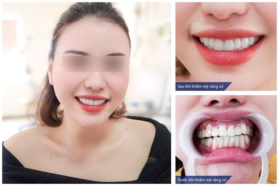 Cảnh báo hậu quả do răng sứ kém chất lượng