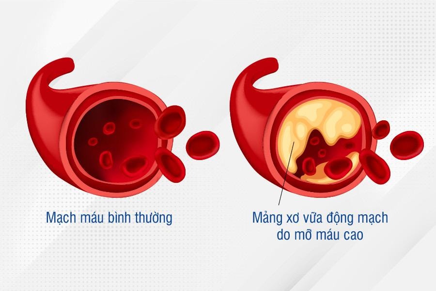 Cảnh giác biến chứng nguy hiểm của bệnh mỡ máu cao