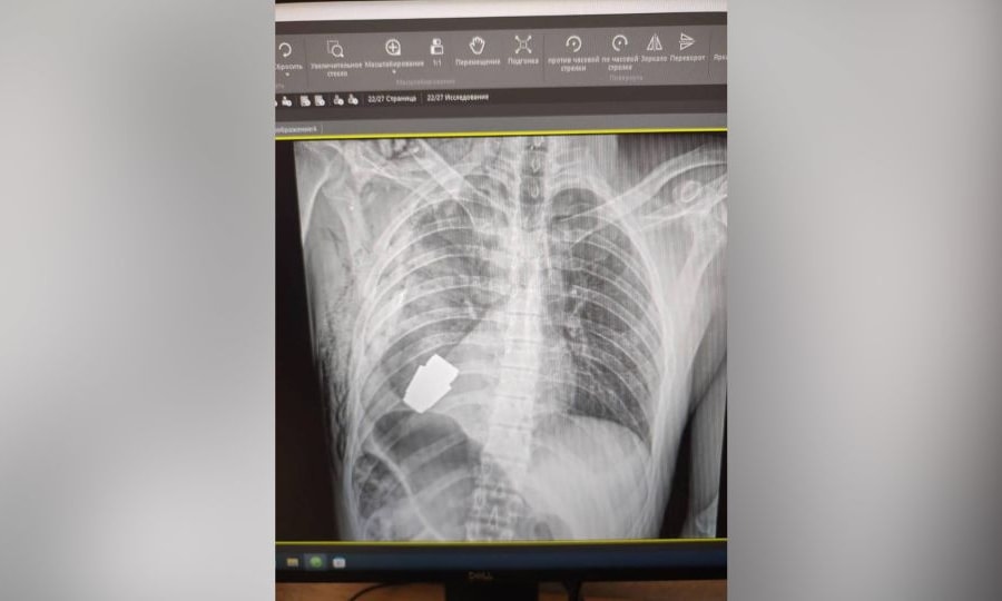 Bác sĩ mổ lấy quả lựu đạn chưa phát nổ trong lồng ngực binh sĩ Ukraine