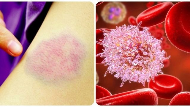 7 dấu hiệu ung thư máu giai đoạn đầu cần biết