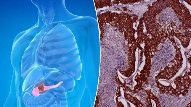 Tỷ lệ tử vong vì ung thư tuyến tụy tăng nhanh ở phụ nữ dưới 55 tuổi