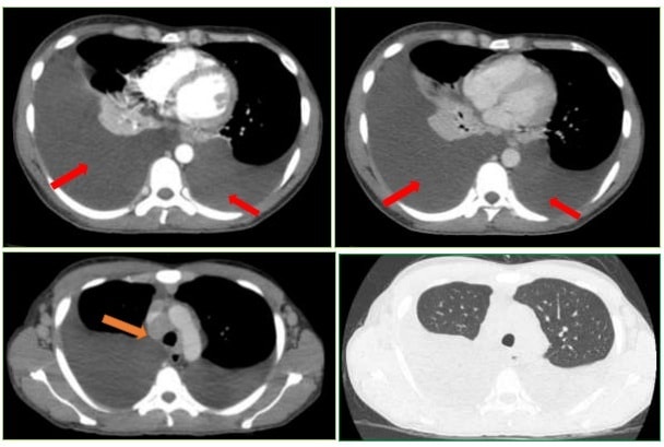 Phát hiện mắc hai bệnh ung thư từ dấu hiệu mờ nhạt