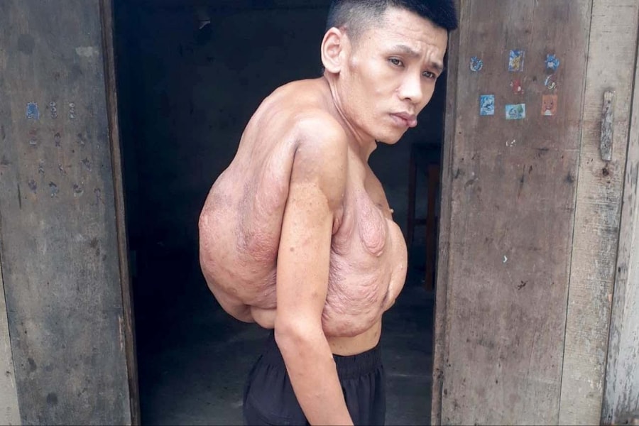 Chàng trai đáng thương 'cõng' khối u 'khổng lồ' suốt hơn 20 năm