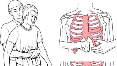 Xử trí nghẹn thức ăn, hóc dị vật bằng nghiệm pháp Heimlich cần biết những điều này