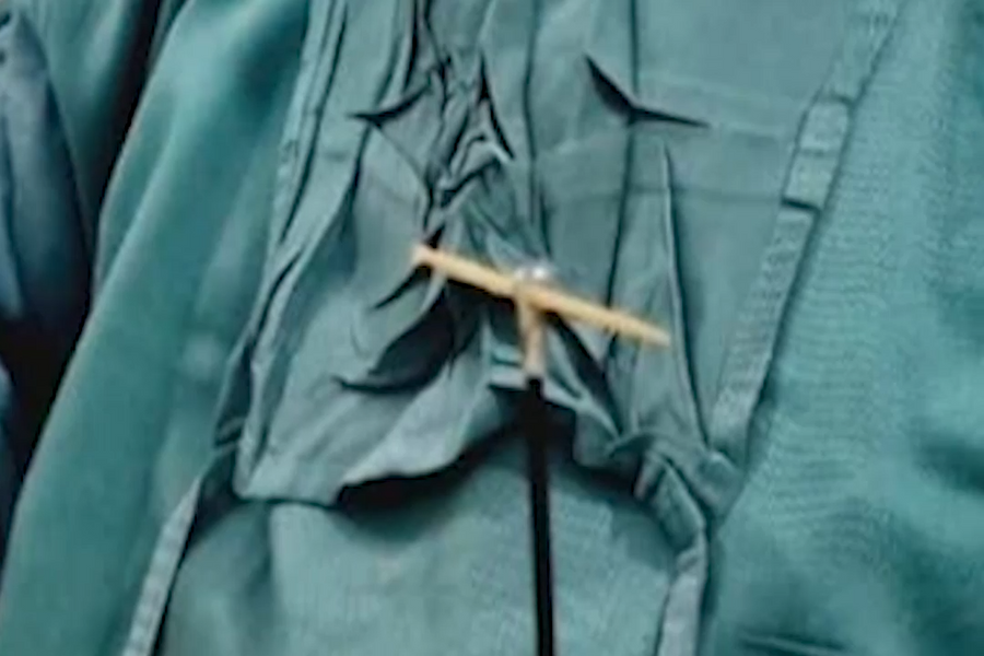 Hy hữu: Gắp tăm tre dài 5cm trong dạ dày bệnh nhân