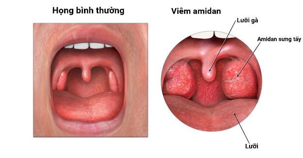 Xoa bóp huyệt vị hỗ trợ điều trị viêm họng