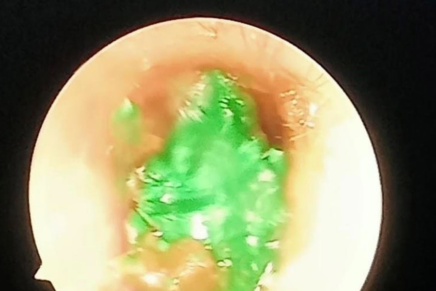 Gây mê lấy dị vật trong tai bệnh nhi 46 tháng tuổi ở Nghĩa Đàn