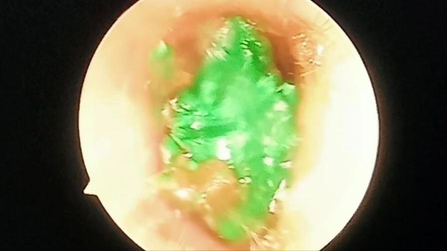 Gắp thành công dị vật là đất sét trong tai trẻ nhỏ