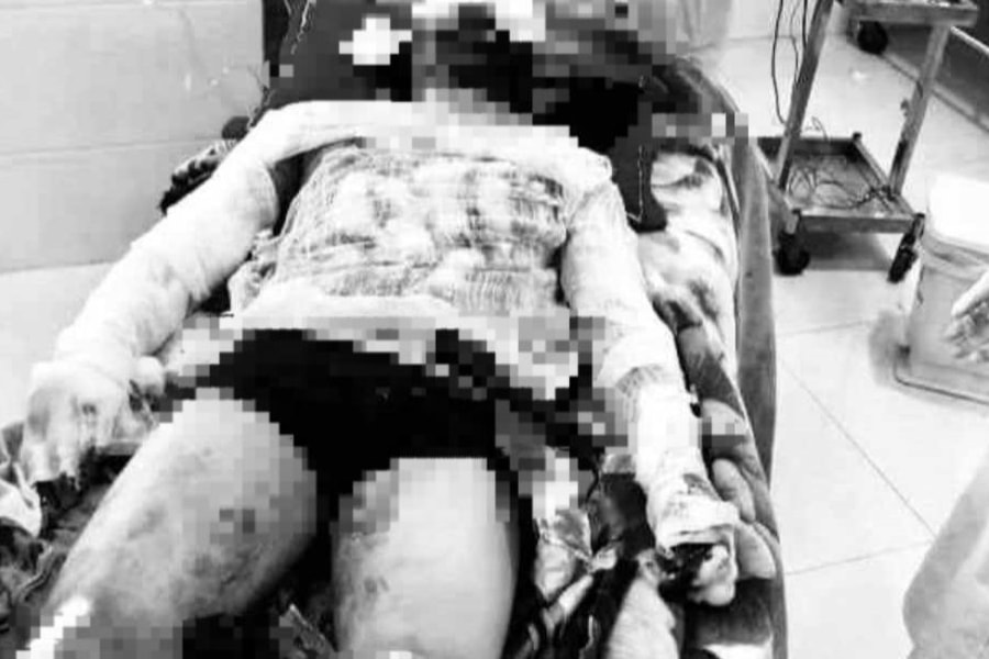 Nam thanh niên ở Diễn Châu bị bỏng nặng vì pháo tự chế