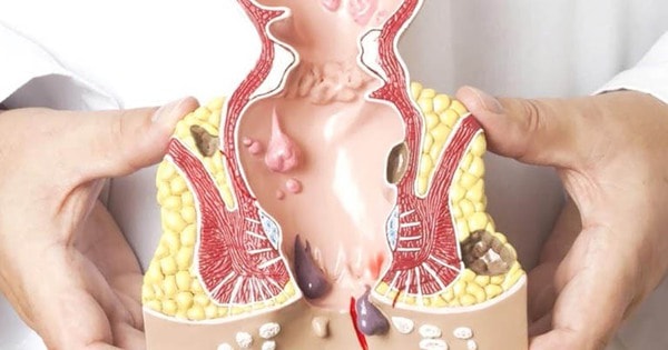 Bệnh trĩ có tự khỏi không, cần làm gì khi mắc trĩ?