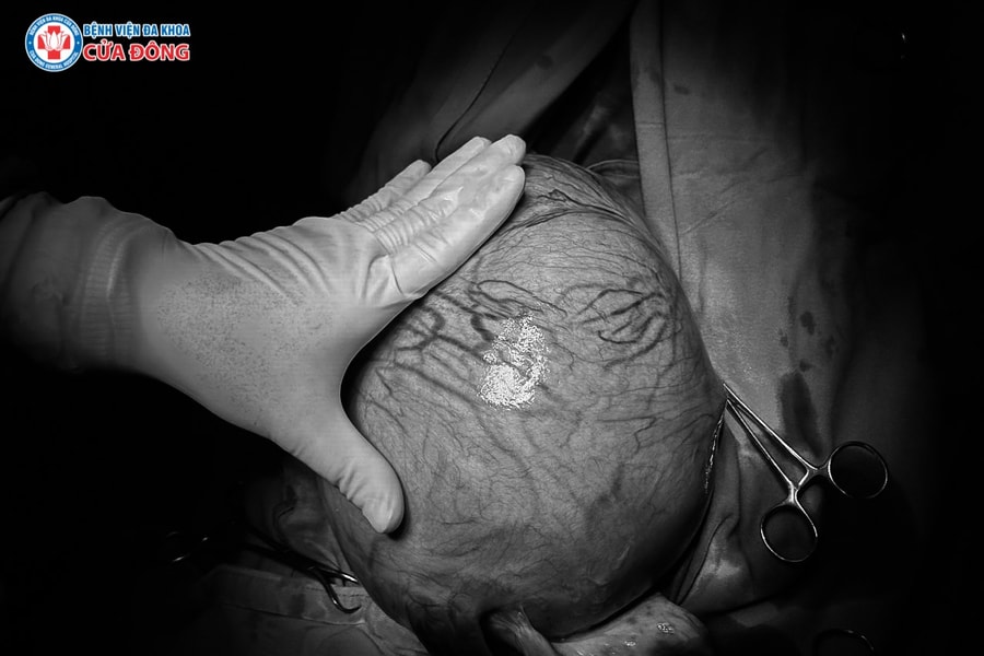 Cắt khối u xơ tử cung kích thước ‘khủng’, nặng 4kg cho bệnh nhân Lào