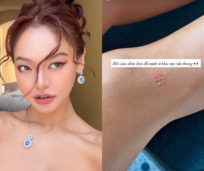 Đại diện Việt Nam Mai Ngô gặp chấn thương trước phần thi Top Model tại Miss Supranational 2026