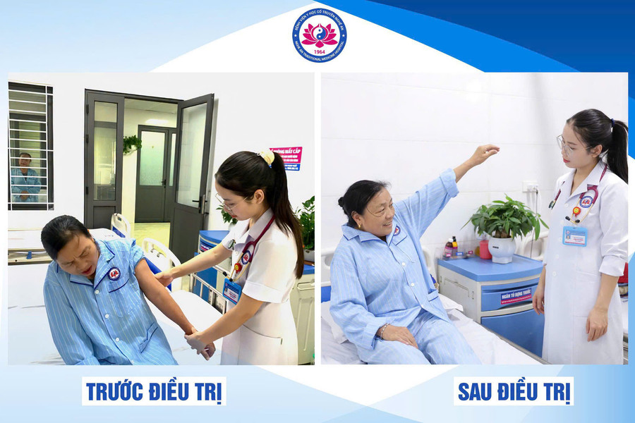 Phục hồi đúng cách - "chìa khóa" khôi phục vận động sau phẫu thuật chóp xoay khớp vai